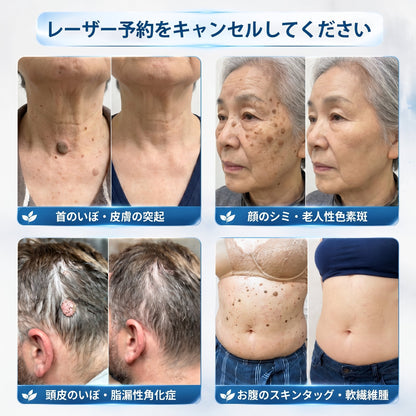 𝐏i𝐜𝐝o®🖤🍬7日間 シミ取り 傷跡ケア ペン(痛みゼロ、傷ゼロのローラーボール)💥