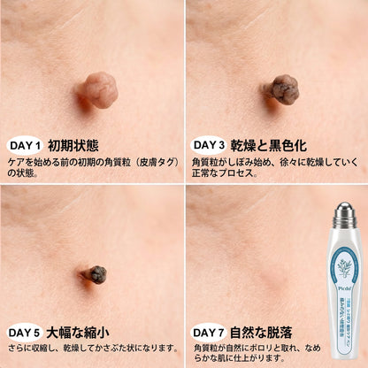 𝐏i𝐜𝐝o®🖤🍬7日間 シミ取り 傷跡ケア ペン(痛みゼロ、傷ゼロのローラーボール)💥