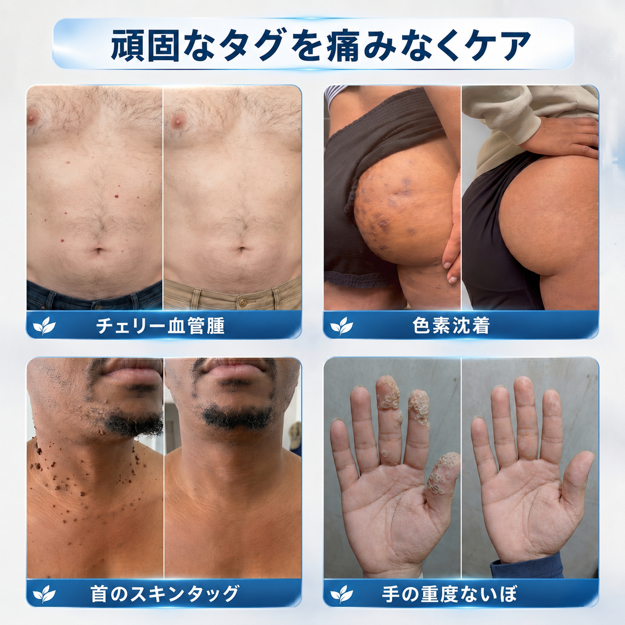 【✨本日最終日・80％OFF】2-in-1 マイクロニードル＆ハイドロコロイドパッチ｜盛り上がったほくろ・ニキビ・扁平イボ・スキンタッグを集中ケア｜シワ・傷跡・肌の気になる部分をなめらかに整える｜顔・ボディ用の目立ちにくい透明パッチ