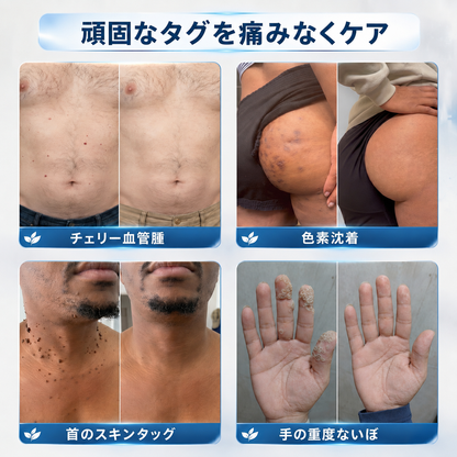 【✨本日最終日・80％OFF】2-in-1 マイクロニードル＆ハイドロコロイドパッチ｜盛り上がったほくろ・ニキビ・扁平イボ・スキンタッグを集中ケア｜シワ・傷跡・肌の気になる部分をなめらかに整える｜顔・ボディ用の目立ちにくい透明パッチ