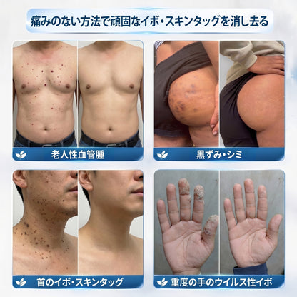 𝐏i𝐜𝐝o®🖤🍬7日間 シミ取り 傷跡ケア ペン(痛みゼロ、傷ゼロのローラーボール)💥